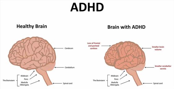 ADHD in Adults: Symptoms and Strategies